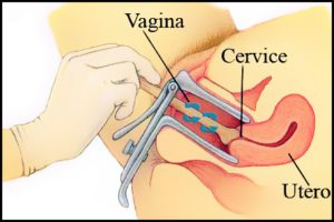 Pap test e prevenzione per il cancro